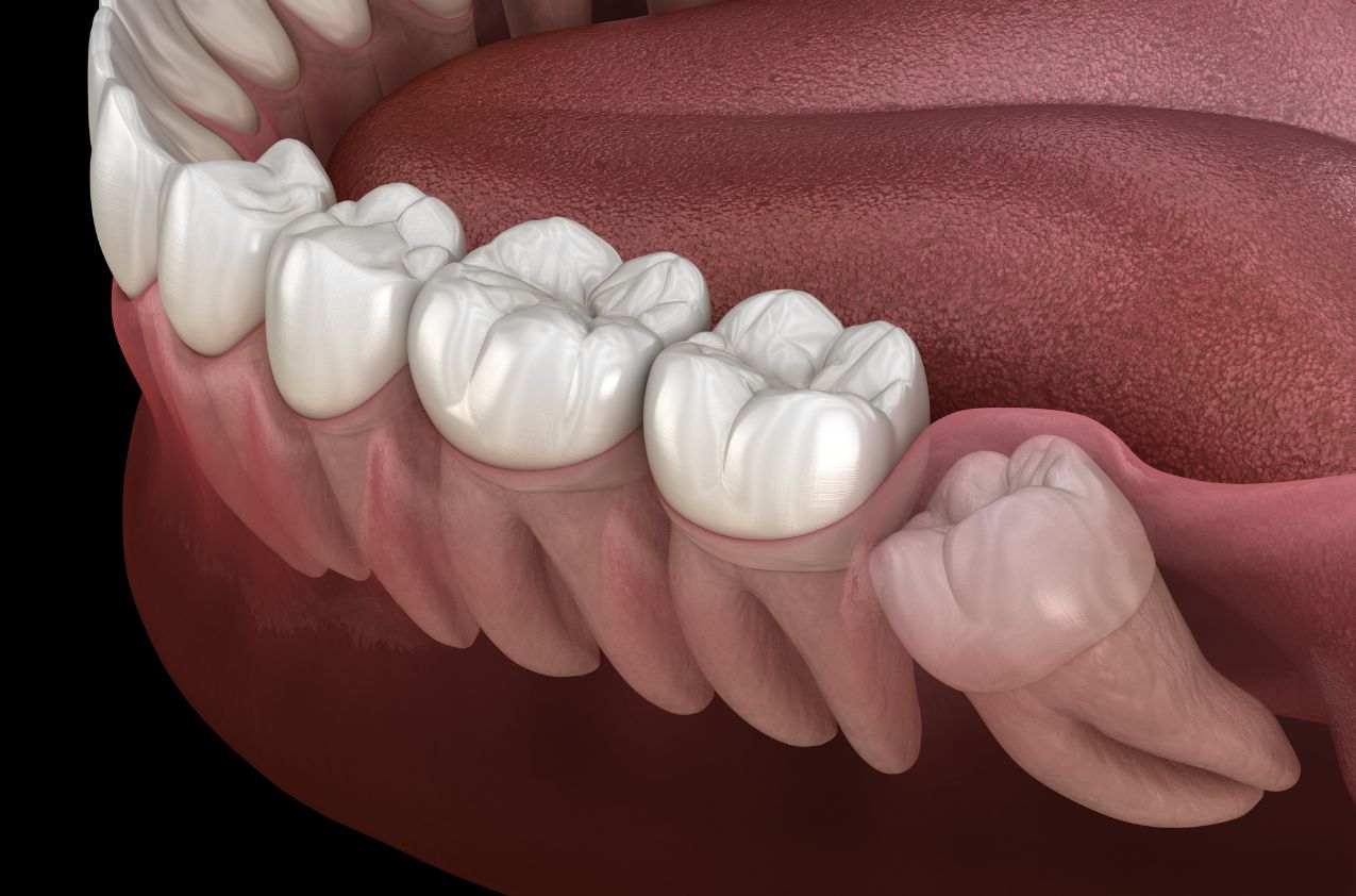 Kenali Impaksi Gigi dan Cara Mengatasinya